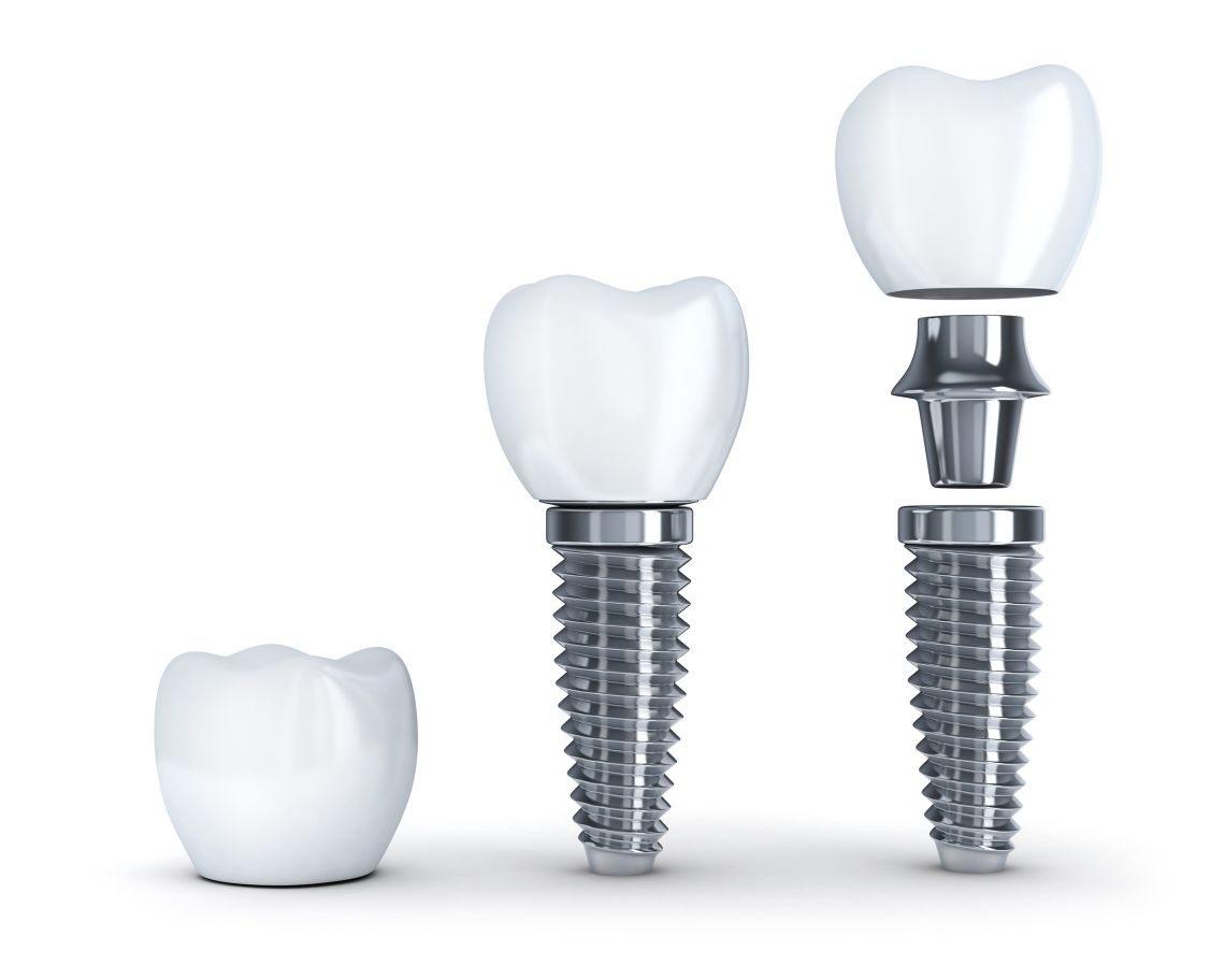 Dental Implant Event