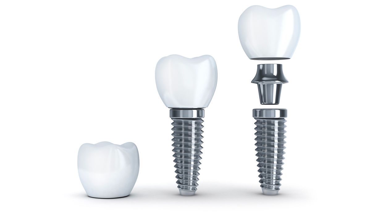 Dental Implants image