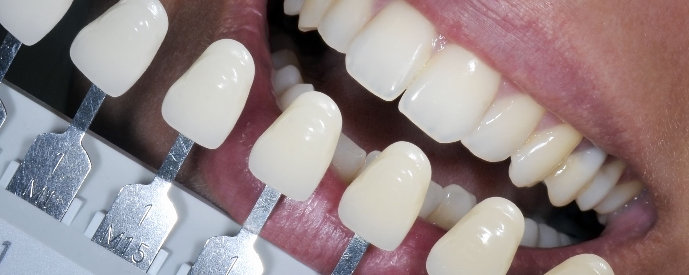 Ultimate Teeth Whitening Packages