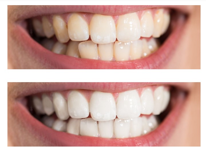 Teeth before and after professional whitening